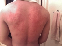 Alkol Alerjisi Belirtileri ve Tedavisi Alkol Alerjisi Belirtileri ve Tedavisi