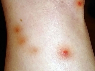 Pire Alerjisi Belirtileri ve Tedavisi Pire Alerjisi Belirtileri ve Tedavisi