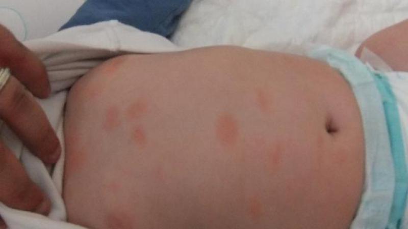 Bebeklerde Ceviz Alerjisi