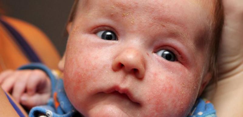 Bebeklerde Polen Alerjisi Belirtileri